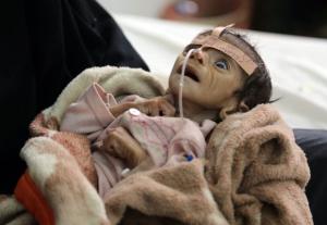 In this Tuesday, March 22, 2016 photo, infant Udai Faisal, who is suffering from acute malnutrition, is hospitalized at Al-Sabeen Hospital in Sanaa, Yemen. Udai died on March 24. Hunger has been the most horrific consequence of Yemenís conflict and has spiraled since Saudi Arabia and its allies, backed by the U.S., launched a campaign of airstrikes and a naval blockade a year ago. (AP Photo/Maad al-Zikry)