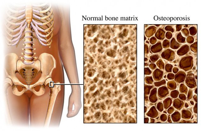 Anak Muda Perkotaan Rentan Osteoporosis Karena Gaya Hidup