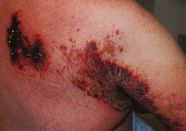 Herpes Zoster Sangat Bahaya! Ini Solusinya bagi Penderita