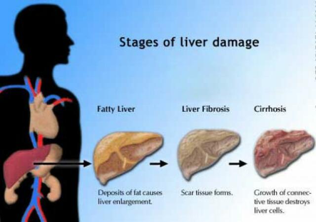 Pakar: Konsumsi Garam dan Gula Seimbang Cegah Penyakit Degeneratif