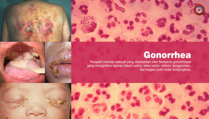 Gonorrhea (Aktual/Ilst.Nelson)