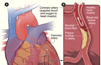 Waspada! Serangan Jantung Koroner Menyerupai Gejala Flu