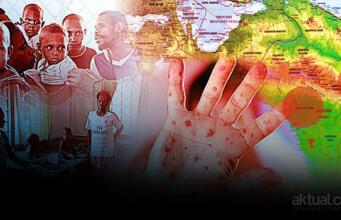 Pemprov Papua Catat Kasus Campak Terjadi di 8 Kabupaten dan 1 Kota