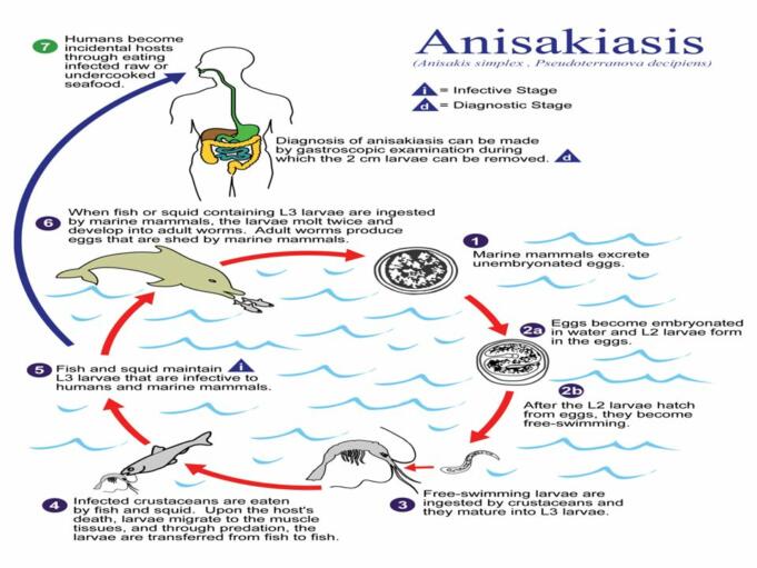 ANISAKIASIS