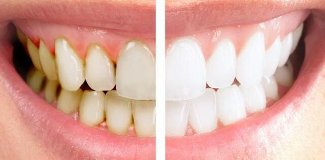 Simak! Ternyata Gigi Berwarna Kuning Itu Alami - Aktual.com