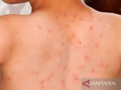 Kasus Campak Harus Jadi Alarm untuk Membangun Kesadaran Pola Hidup Sehat Masyarakat